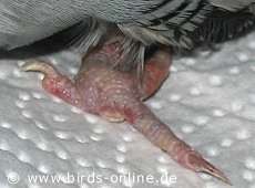 Gichtfuß mit fehlendem Zeh